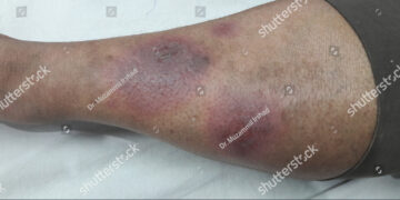 **Erythema Nodosum** lietuviškai: **Mazginė eritema**.