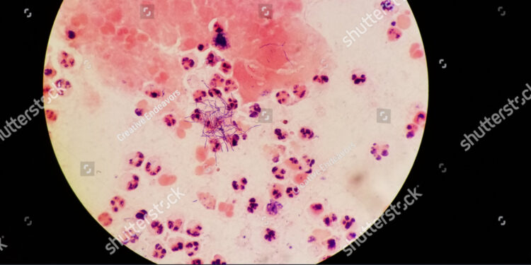 **Nokardijos sukelta infekcija (nokardiozė)**