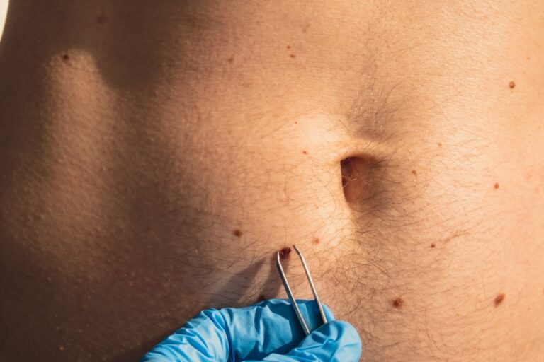 Dermatologas apžiūri paciento apgamą