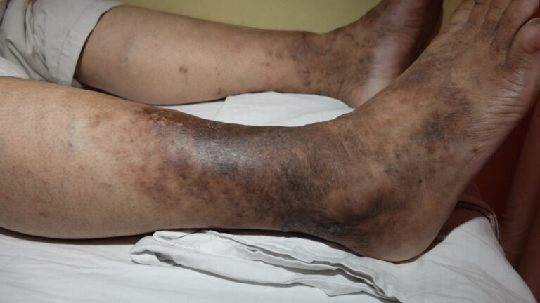 Hemosiderino dėmės ir hiperpigmentacija blauzdų srityje