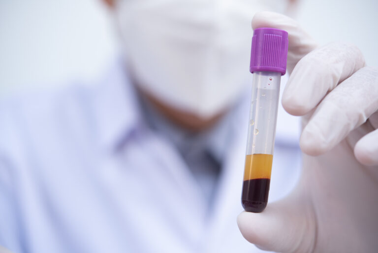 Laboratorijos darbuotojas laiko kraujo mėginio mėgintuvėlį